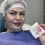 بلفاروپلاستی با بخیه لیزری (پلاستیک) بدون جای بخیه تضمینی تبریز