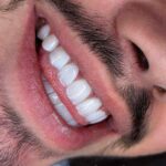 کامپوزیت دندان ایمپلنت لمینت عصب کشی در کرج کلینیک ماهانا