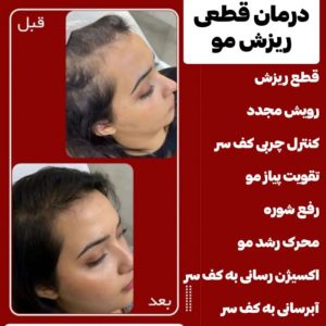 ریزش مو