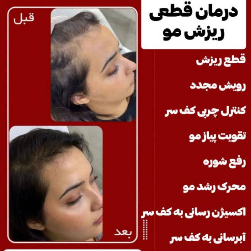 ریزش مو