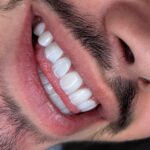 خدمات کامپوزیت، ایمپلنت و لمینت دندان در کلینیک ماهانا در کرج